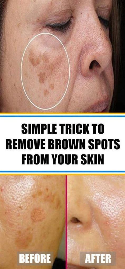 Find Out Who Is Worried About Remove Brown Spots And Why You Should Pay