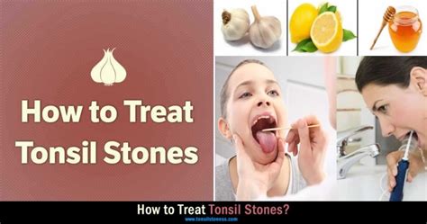 Tonsil Stones Guide Causes Symptoms Removal And Prevention