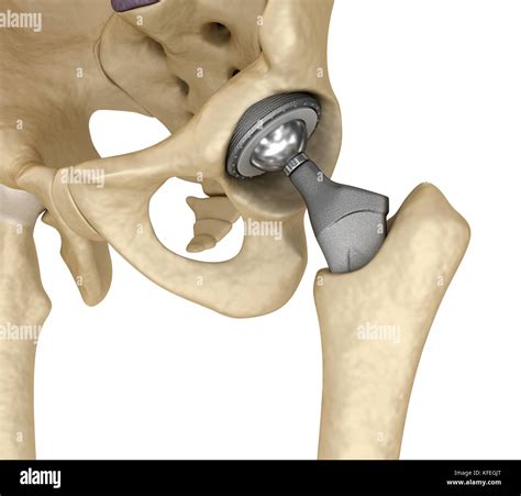 Hip Replacement Implant Installed In The Pelvis Bone Medically