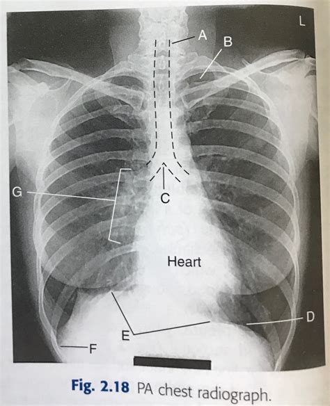 X Ray Anatomy Pa Chest Diagram Quizlet