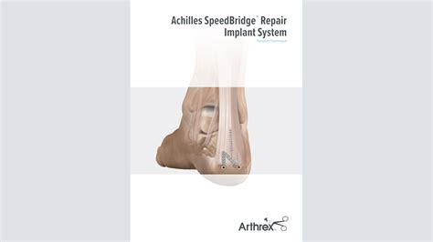 Arthrex Achilles Speedbridge Repair