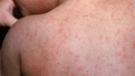 Measles Outbreak In Arizona Is Biggest Of Season So Far