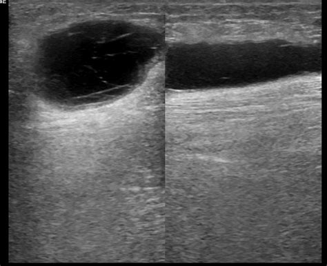 Soft Tissue Hematoma Thigh Image