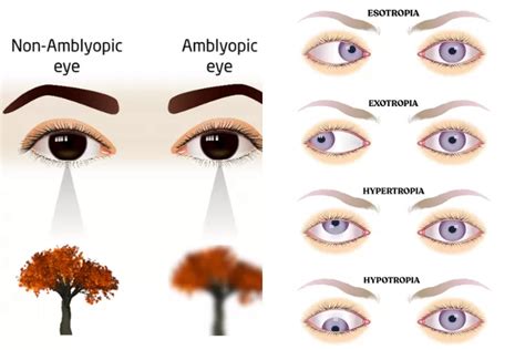 Apa Itu Gangguan Amblyopia Mata Malas Yuk Kenali Lebih Dalam Jenis Jenis Penyebab Gejala