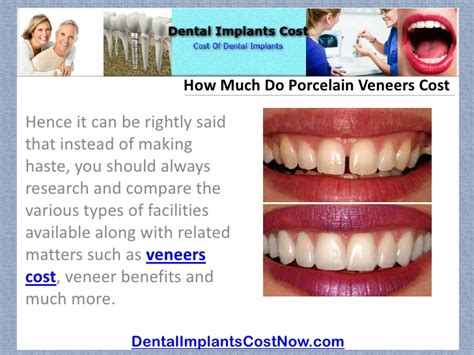 Dental veneers are porcelain or composite shells coating the surface of the teeth to correct the shape, color, and veneers cost depends mainly on substance used — composite, porcelain or cerinate porcelain substance. How Much Do Porcelain Veneers Cost