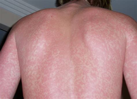 How To Tell If A Rash Needs Medical Attention Alaska Native News