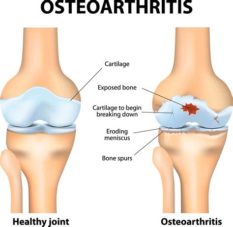 Osteoarthritis Of The Knee Orthopaedic Surgeon In Wantrina Melbourne Knox Orthopaedic Group