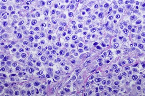 Diffuse Large B Cell Lymphoma Karyopharm Therapeutics