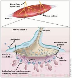 Myasthenia gravis (mg) is a relatively rare autoimmune disorder in which antibodies form against acetylcholine nicotinic postsynaptic receptors at the neuromuscular junction of skeletal muscles (see the image below). Diseases - Muscular System