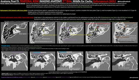 Temporal Bone Imaging Anatomy Middle Ear Cavity Grepmed