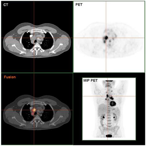 Petct Scan Of A Hodgkin Lymphoma Histologically Validated Doccheck