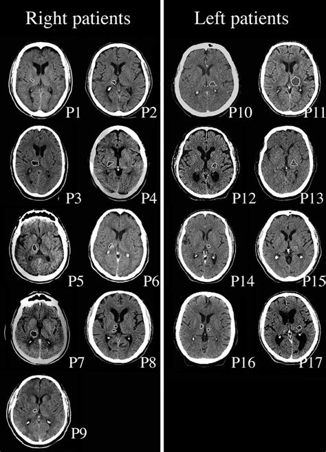 Ct Scans Of Thalamic Lesions In All 17 Patients Each Patient Is