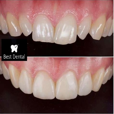 Best Dental Clinic Direct Composite Restorations