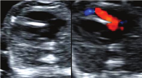 Unilateral Perfusion Of Right Ventricle In Fetus With Hypoplastic Left