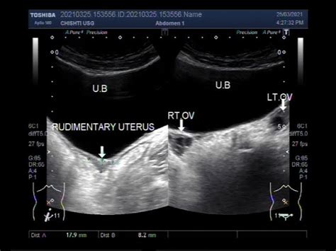 Mullerian Agenesis Ultrasound