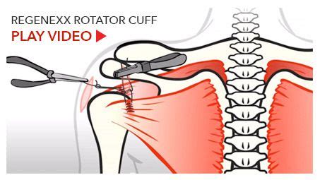 What is the best treatment for shoulder injury? Stem Cell for Shoulder Repair Without Surgery | Regenexx ...