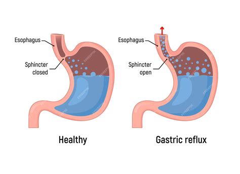 Premium Vector Esophageal Gastric Reflux Acid Indigestion