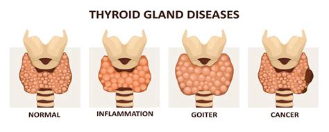 Why Do I Have Thyroid Nodules Rfa For Life Blog