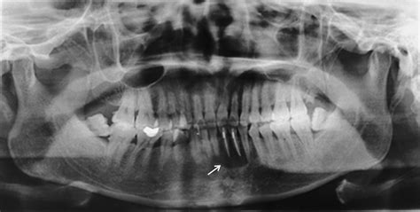 Primary Intraosseous Adenoid Cystic Carcinoma Of The Jaw Clinical And