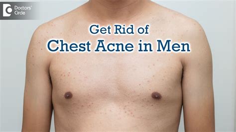 All About Pimples On Male Chest Chest Acne Causes Best Cure Dr Rajdeep Mysore Doctors