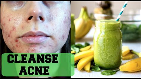 Clear Acne With This Green Smoothie Get Rid Of Acne Through Detox