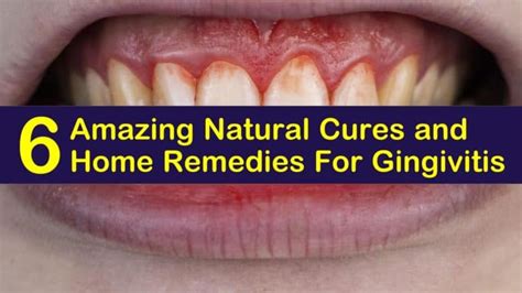 6 Natural Cures And Home Remedies For Gingivitis