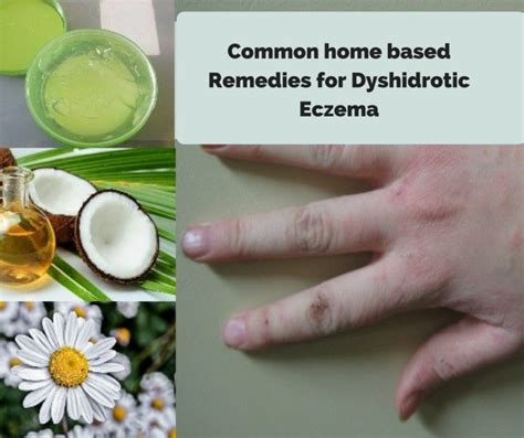 Dyshidrotic Eczema Natural Home Remedies And Treatment