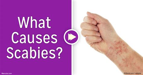 Scabies Rash Pictures Symptoms Treatment Causes Updated Images