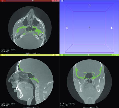 Voxel Based Superimposition On The Cranial Base Using 3d Slicer The