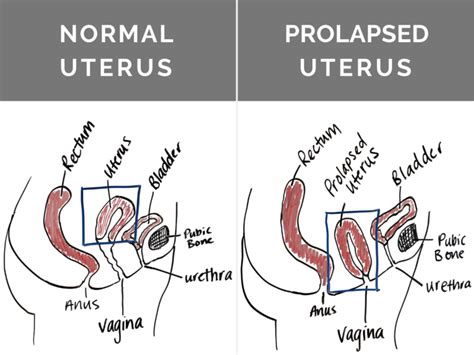 A Surgical Fixation Of A Prolapsed Uterus Is Charted As