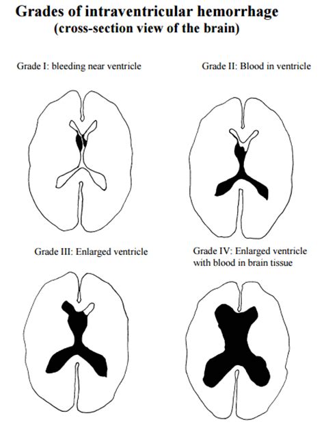 Stages Of Hemorrhage