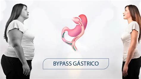 ¿qué Es El Bypass Gástrico Cirugía Bariátrica En Bogotá
