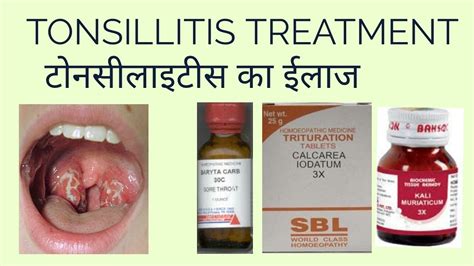 Tonsillitis Treatmentटांसिलाइटिस का ईलाज Youtube