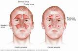 Ethmoid Sinusitis Treatment Photos