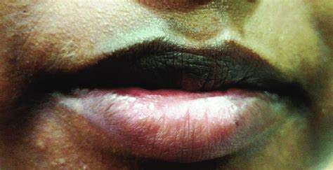 Photograph Demonstrates Post Inflammatory Hyperpigmentation Patches
