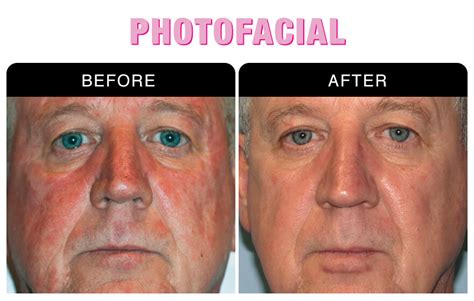 Photofacial Treatment National Laser Institute Medical Spa