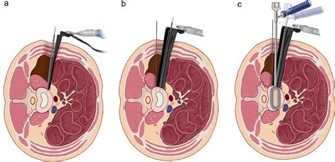 Schematic Diagram Of The Intraoperative Procedure A Initial Position