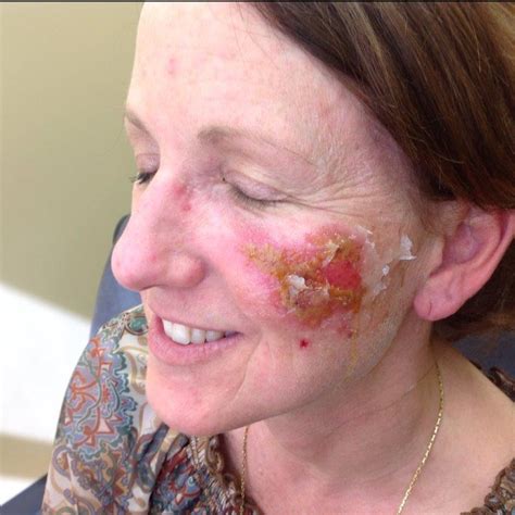 Before and After Pictures of Actinic Keratosis in Charlotte, NC and
