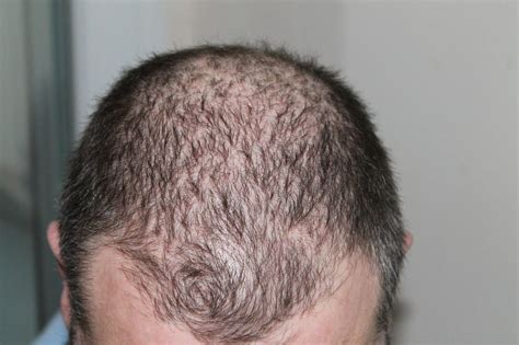 Receding Hairline And How To Stop It Nourishdoc