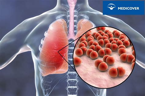 Pneumokoki Objawy Leczenie I Szczepionka Na Pneumokoki