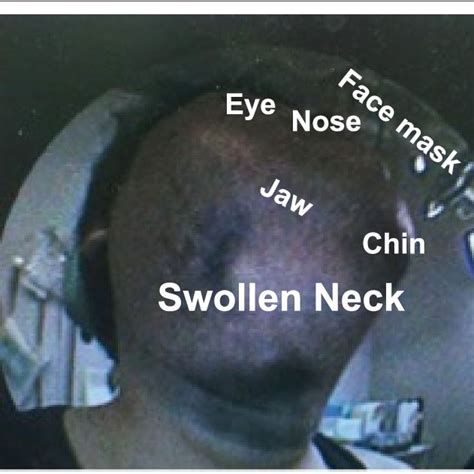 Clinical Photograph Showing The Neck Swelling Caused By The Large