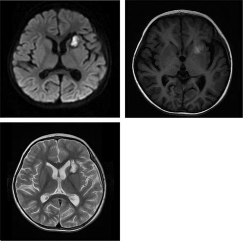 Hemorrhagic Stroke At Left Basal Ganglia Seen On Cerebral Magnetic