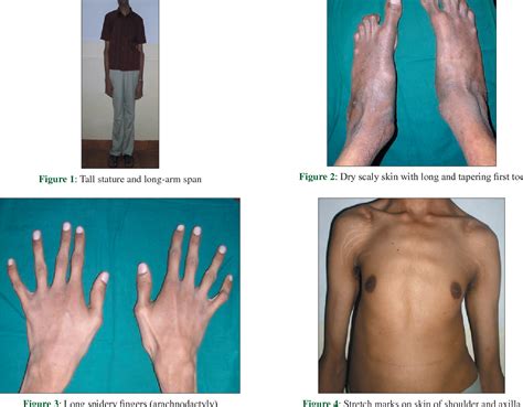 Marfan Syndrome Report Of Two Cases With Review Of Literature Semantic Scholar