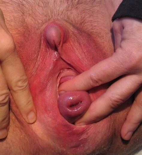 Cervix Prolapse Fucking