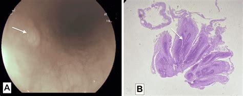 Cureus Esophageal Squamous Cell Papilloma A Report Of Three Cases