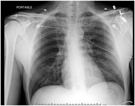Chest Radiograph Showing Mediastinal Air With Extensive Subcutaneous