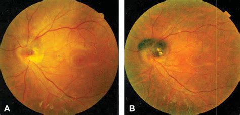 Optic Disk Melanocytoma And Optical Coherence Tomography Angiography