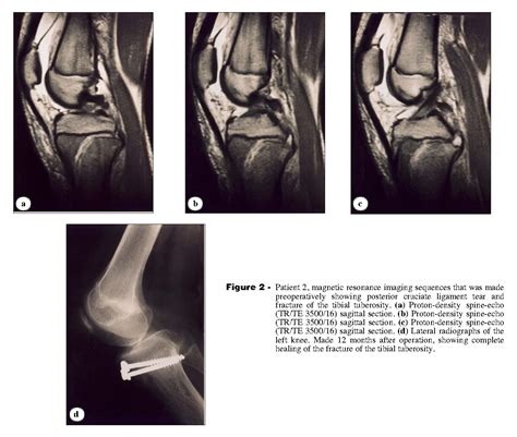 Figure 2 From Avulsion Fractures Of Tibial Tuberosity In Adolescents