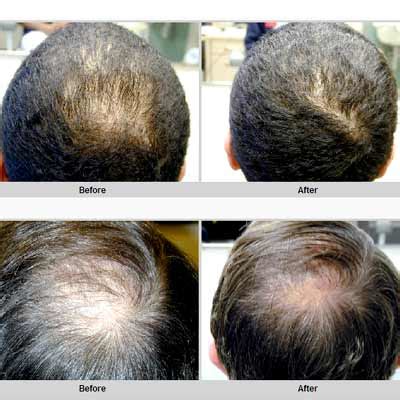 Olive oil for hair can be used by almost all people but people with oily skin should reduce the content of olive oil to avoid greasy hair symptoms. Best home remedies: Home remedies for Hair fall