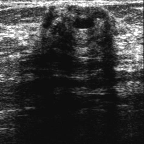 Correlation Between Sonographic Findings And Clinicopathologic And